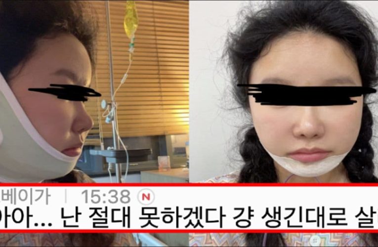 성형 여러번 해본 사람들도 너무 아파서 하다가 중간에 도망간다는 시술