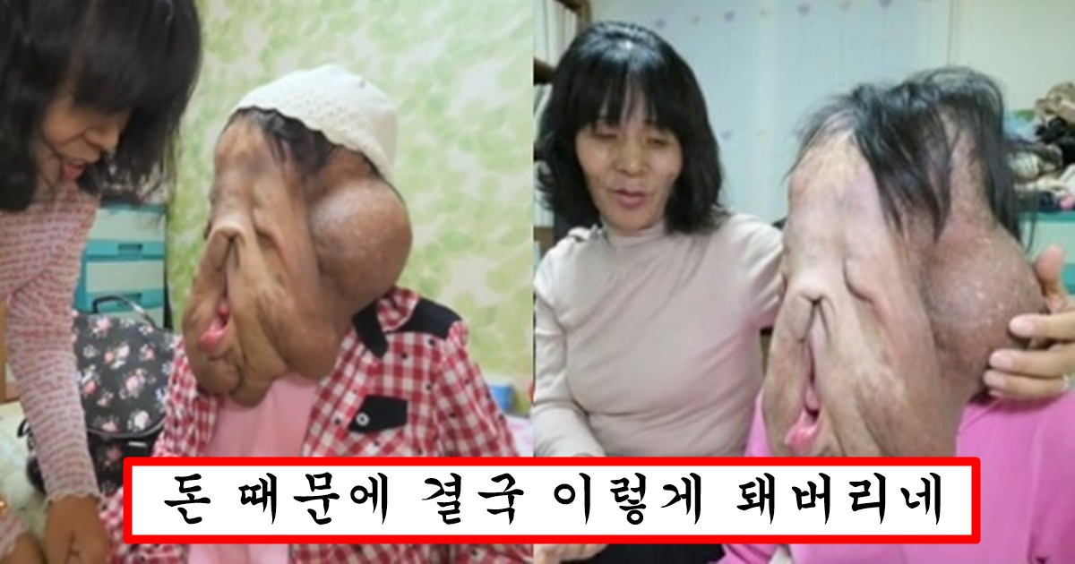 세상에 이런일이 33세 여인의 무너진 얼굴 심현희씨 충격 근황