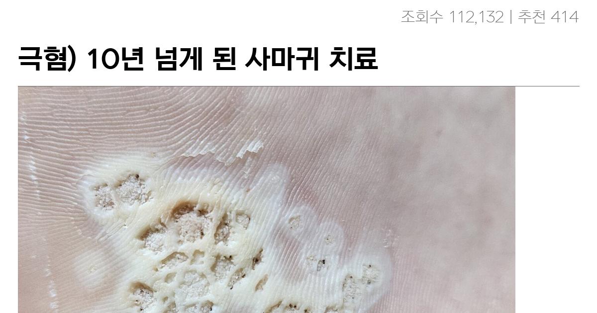 극혐) 10년 넘게 된 사마귀 치료 중인데 올려봄