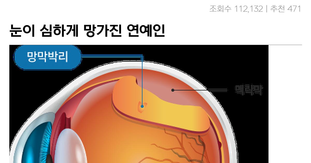 눈이 심하게 망가진 연예인